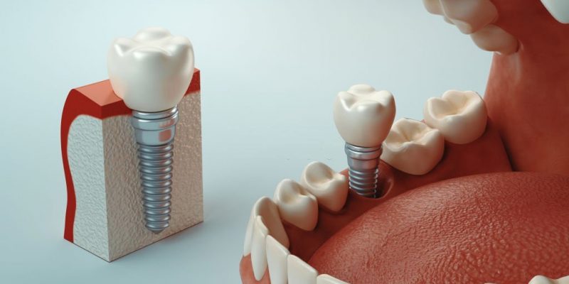 The Reality About Dental Implants