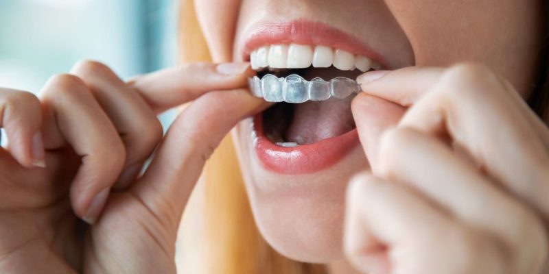 A Perfect Smile With Invisalign Aligners