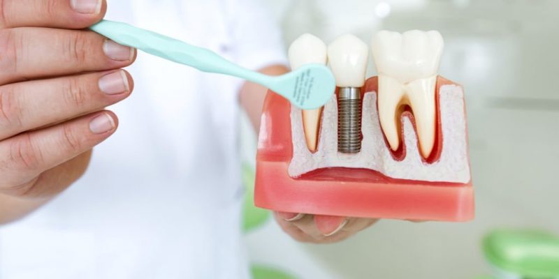 How Long Does A Dental Implant Procedure Take?