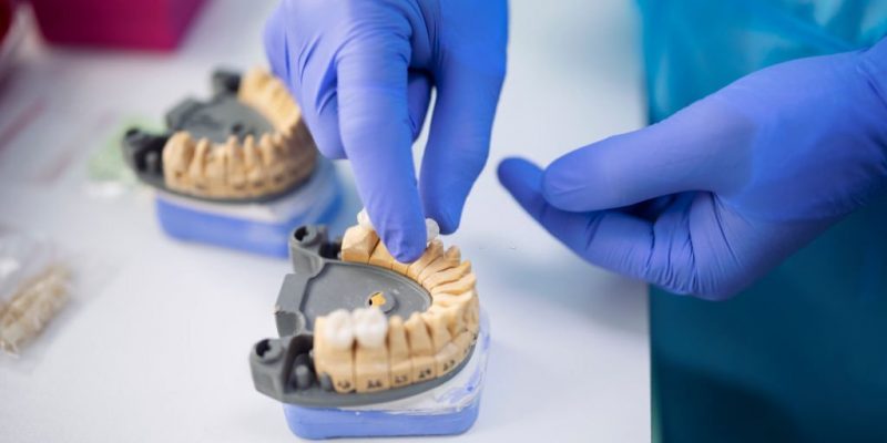 What is a Dental Crown and How Long Does It Last