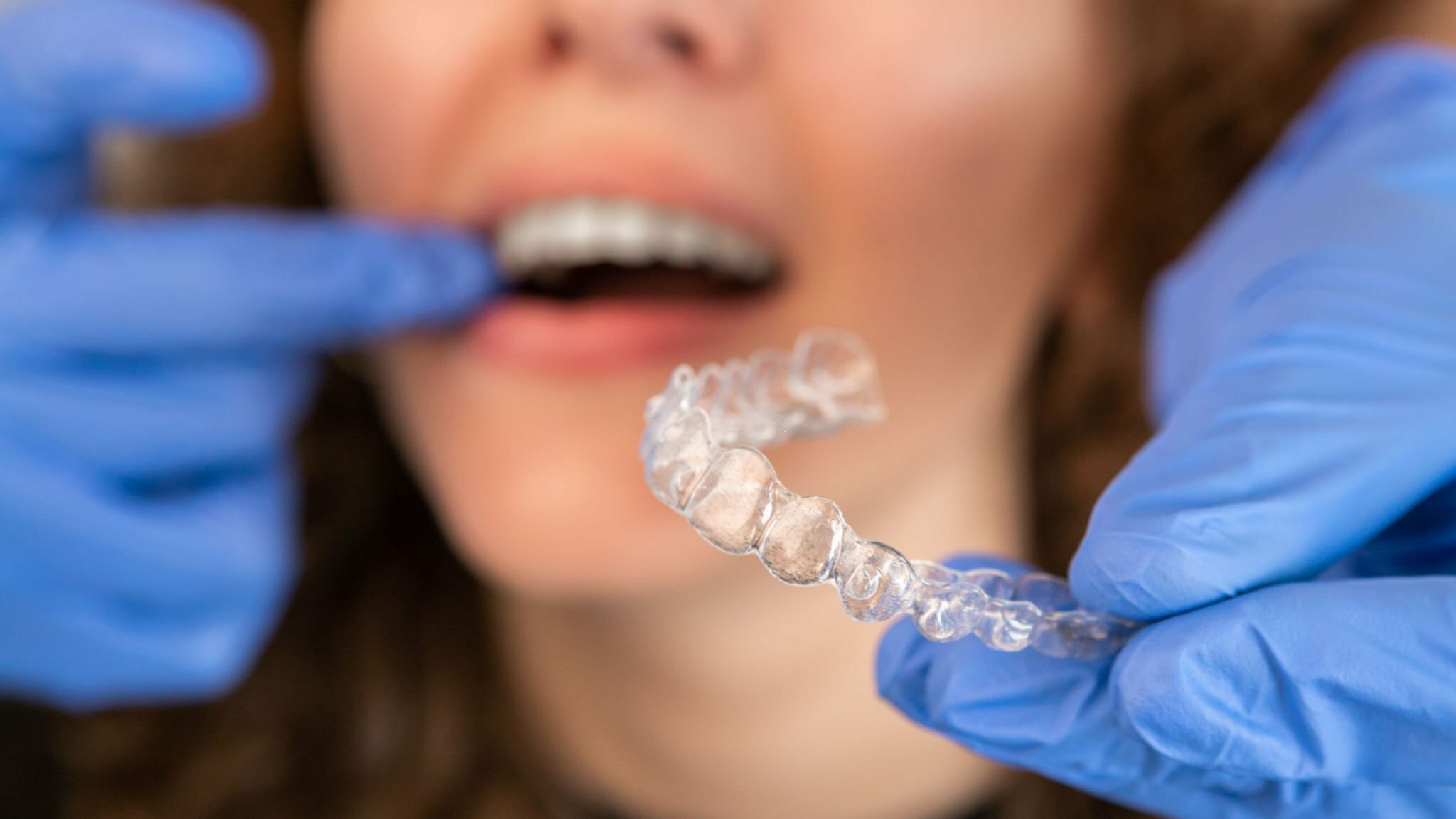 The Impact of Invisalign on Your Oral Health in Lubbock