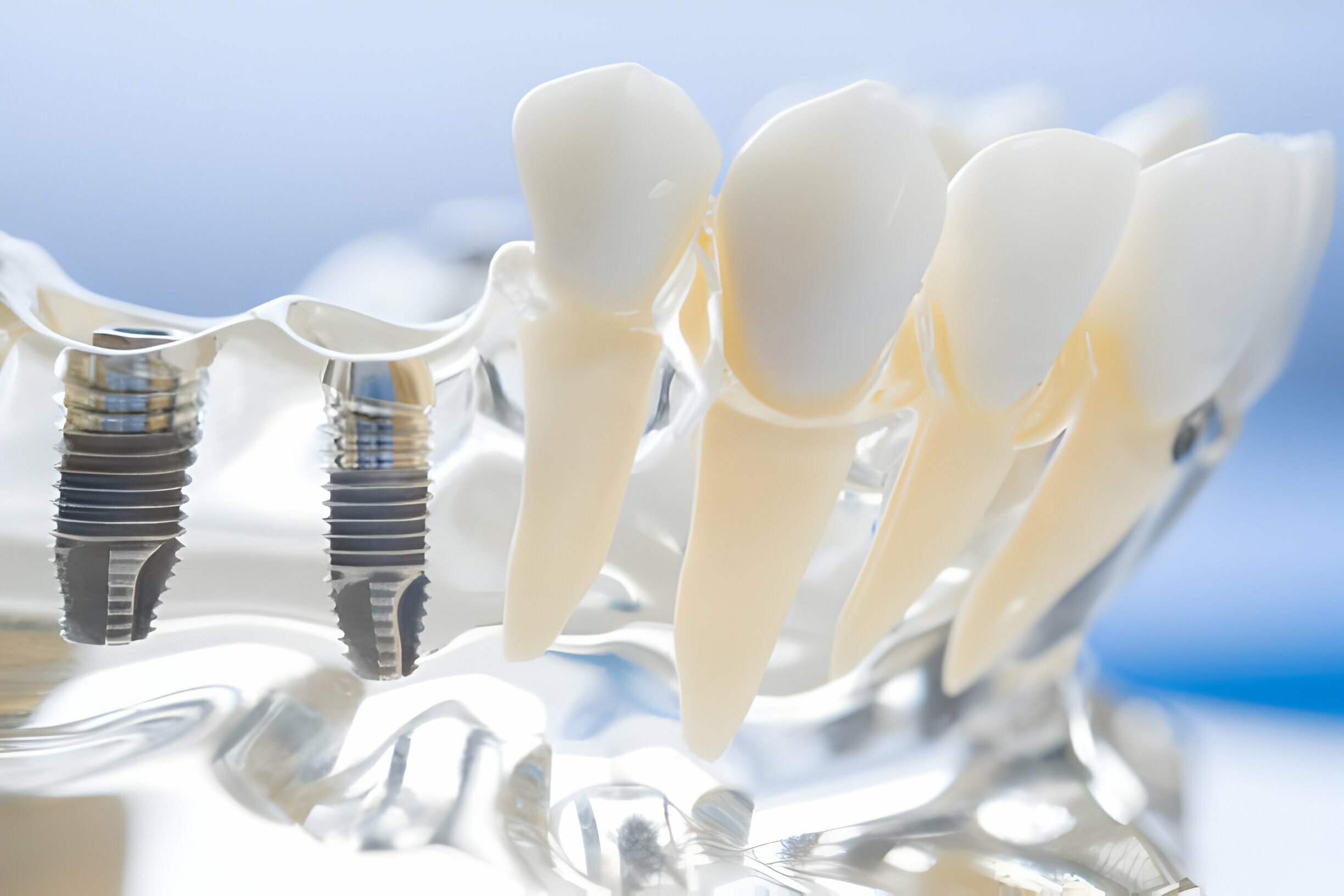 The Impact Of Dental Implants On Your Oral Health_1