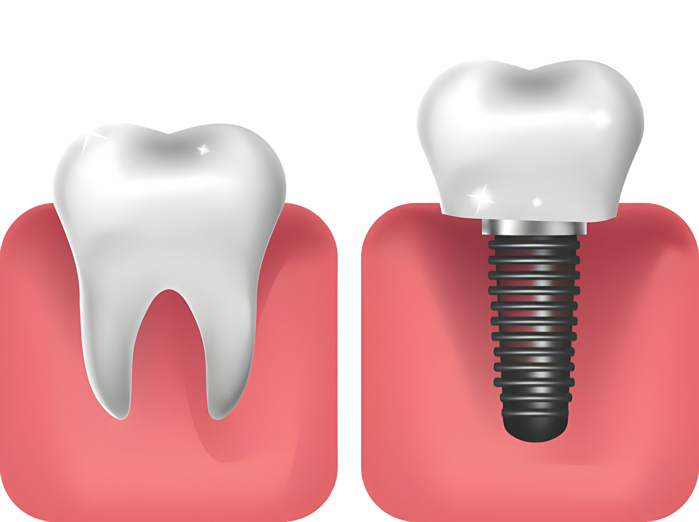 The Impact Of Dental Implants On Your Oral Health_2