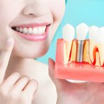 The Impact Of Dental Implants On Your Oral Health_FI