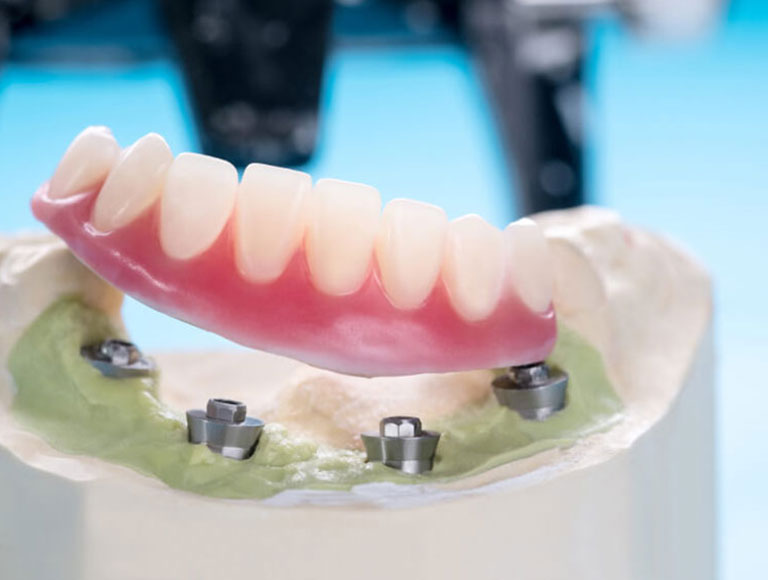 Why Lubbock Patients Choose All-On-4®:
