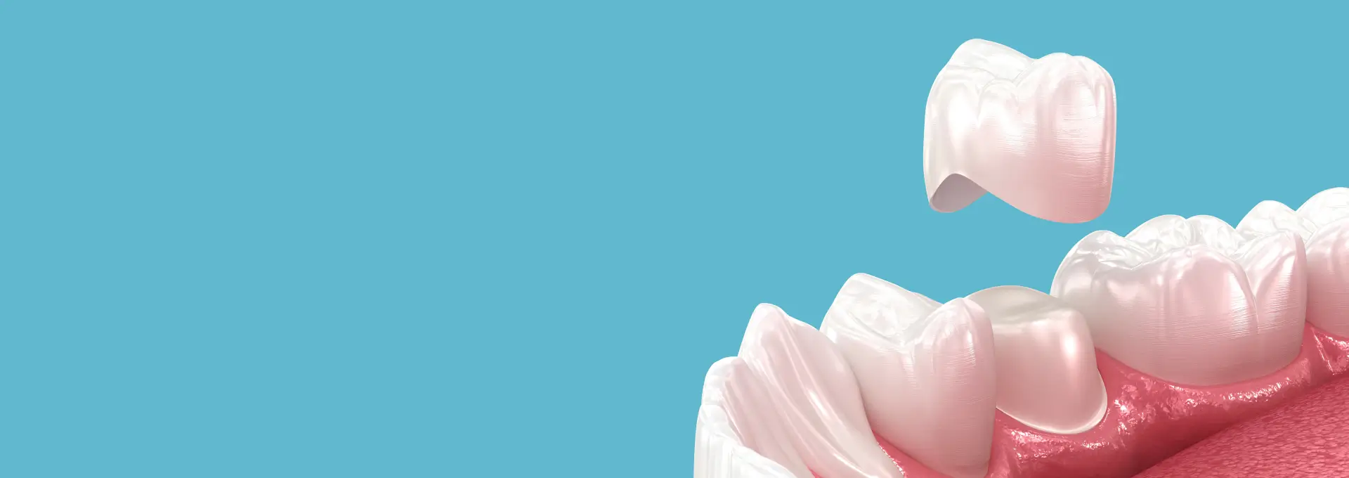Dental Crowns Banner Image