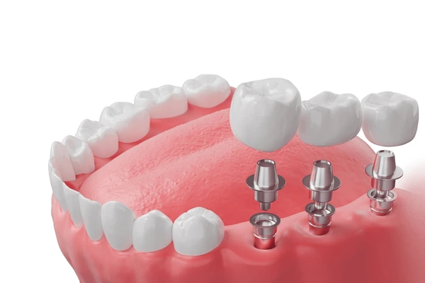 Single dental implant diagram showing titanium post, abutment, and crown components